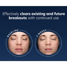 Load image into Gallery viewer, Before and after comparison of skin with acne treatment showing effectiveness.