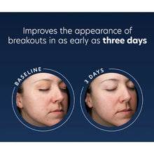 Load image into Gallery viewer, Before and after comparison of a person's face with text indicating improvement in breakout appearance.
